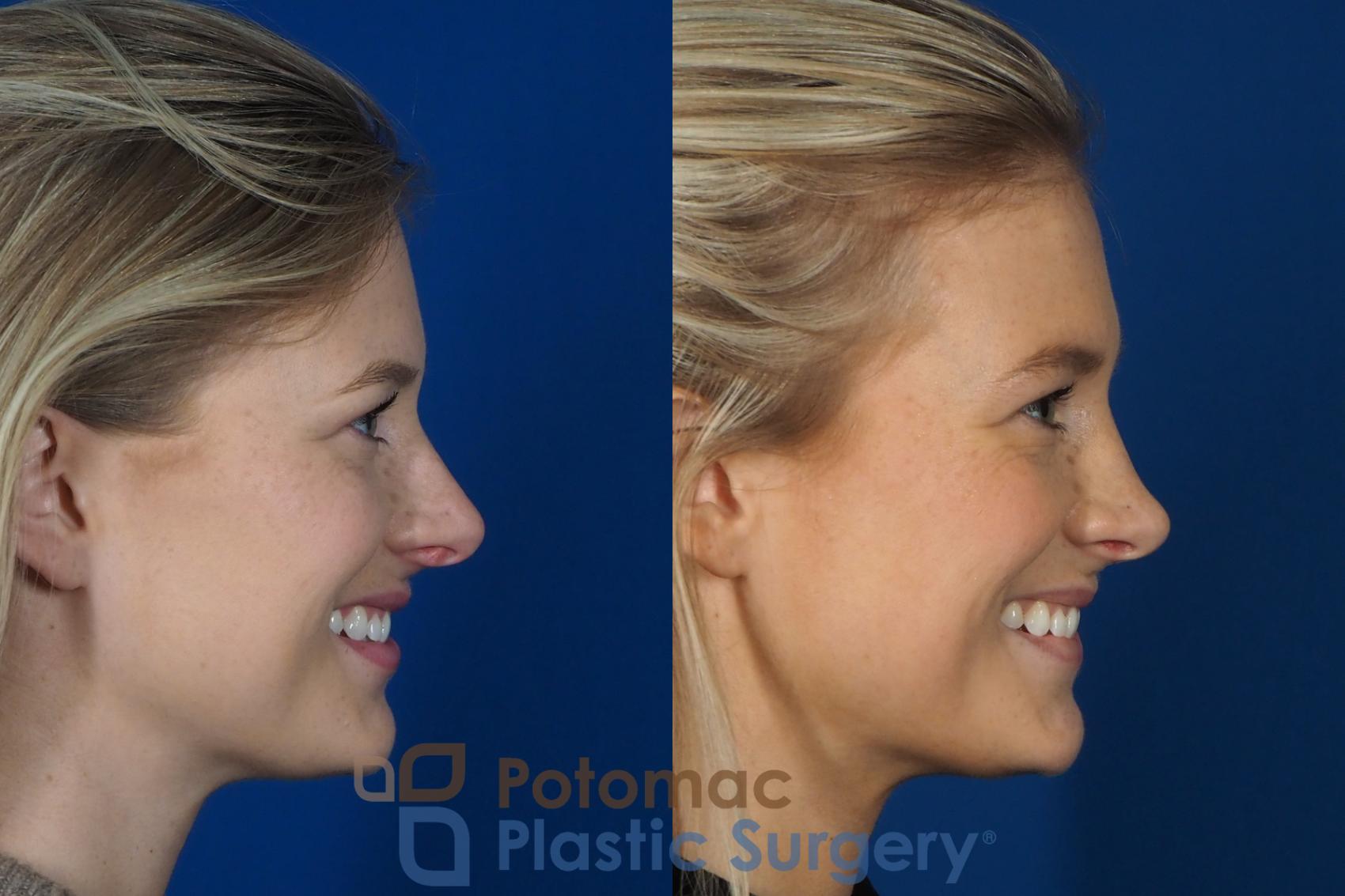 Before & After Rhinoplasty - Cosmetic Case 248 Right Side - Smiling View in Washington, DC
