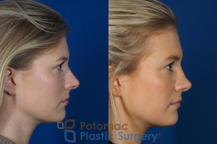 Before & After Rhinoplasty - Cosmetic Case 248 Right Side View in Washington DC & Arlington , DC