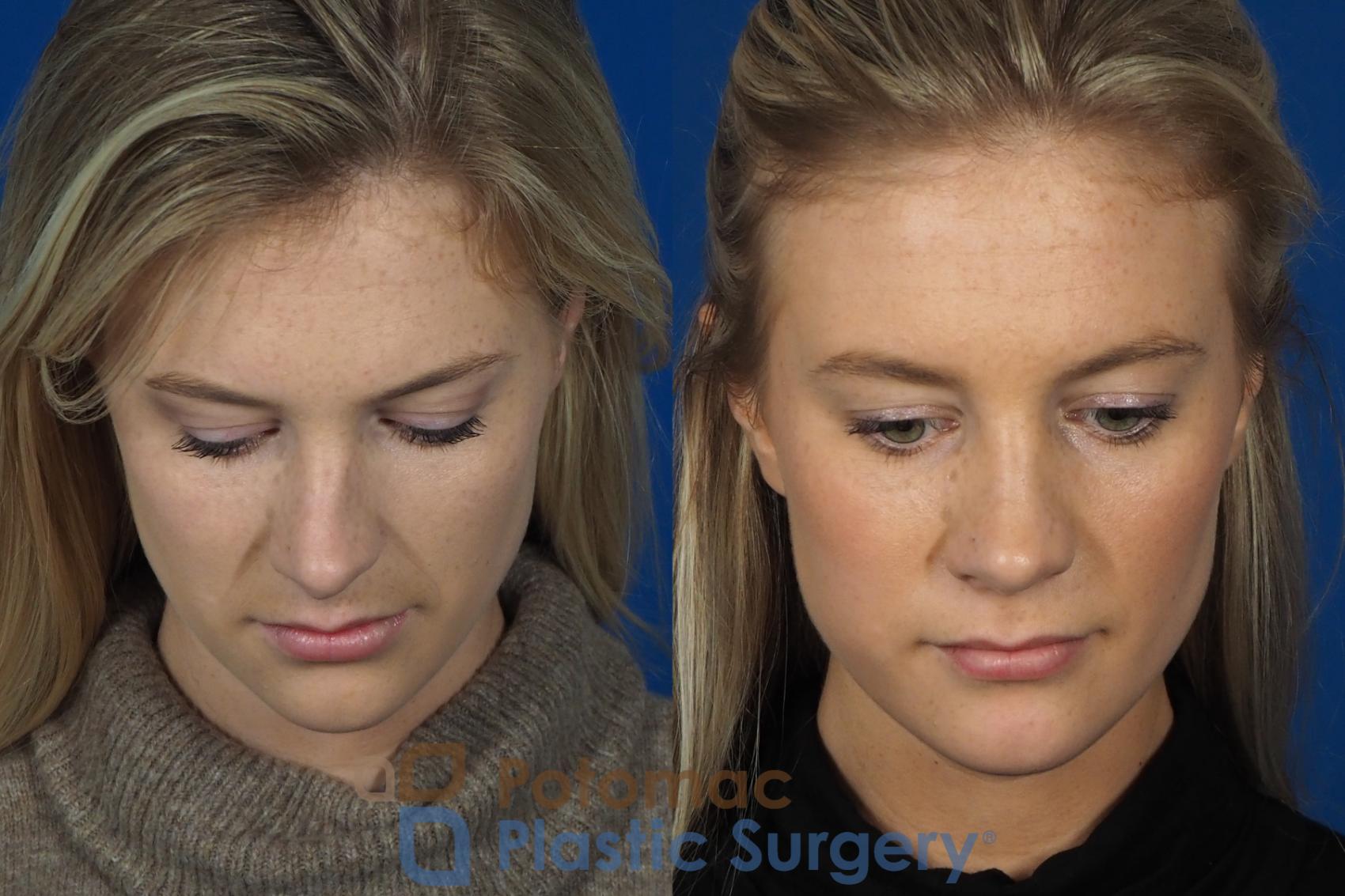 Before & After Rhinoplasty - Cosmetic Case 248 Top View in Washington, DC