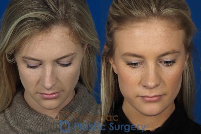 Before & After Rhinoplasty - Cosmetic Case 248 Top View in Washington DC & Arlington , DC
