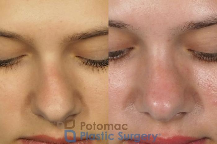 Before & After Rhinoplasty - Medical Case 249 Above View in Washington DC & Arlington , DC