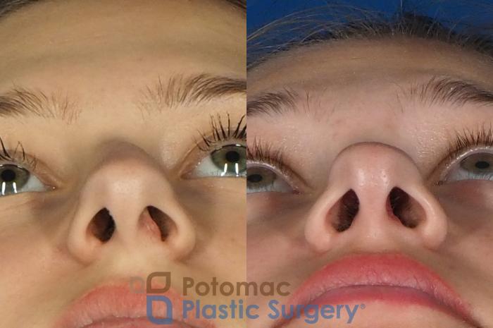 Before & After Rhinoplasty - Medical Case 249 Below View in Washington DC & Arlington , DC