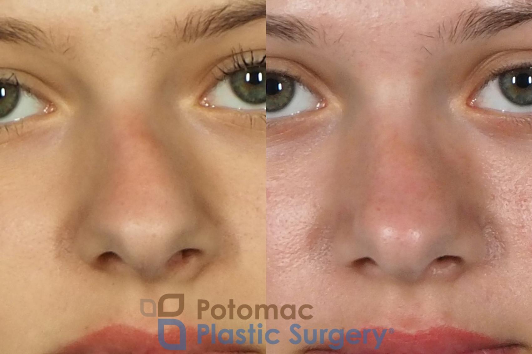 Before & After Rhinoplasty - Medical Case 249 Front View #1 View in Washington DC & Arlington , DC