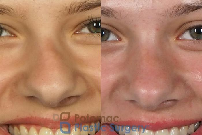 Before & After Rhinoplasty - Medical Case 249 Front View #2 View in Washington DC & Arlington , DC