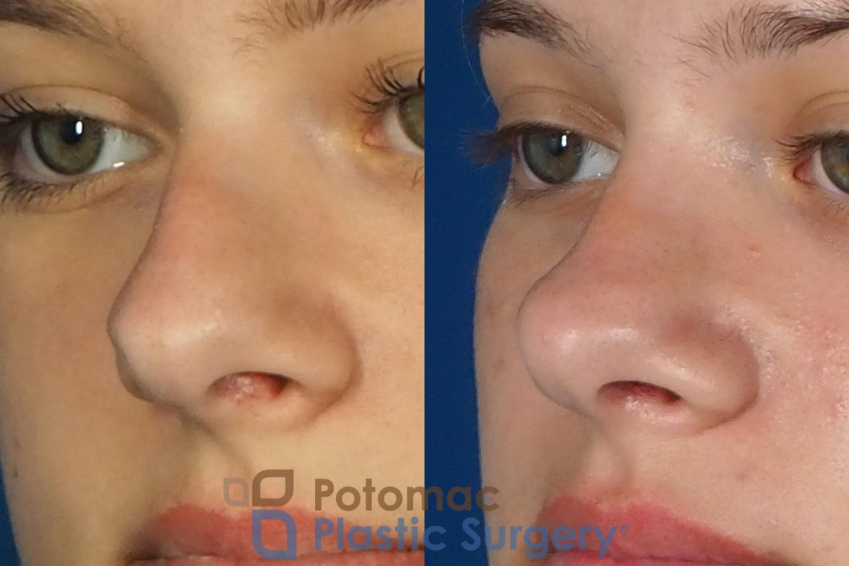Before & After Rhinoplasty - Cosmetic Case 249 Left Oblique View in Washington DC & Arlington , DC
