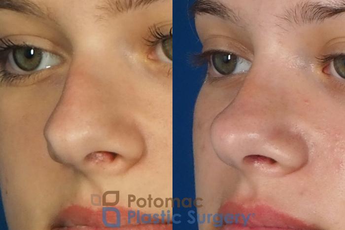 Before & After Rhinoplasty - Medical Case 249 Left Oblique View in Washington DC & Arlington , DC