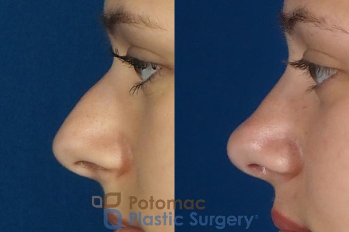 Before & After Rhinoplasty - Cosmetic Case 249 Left Side View in Washington, DC