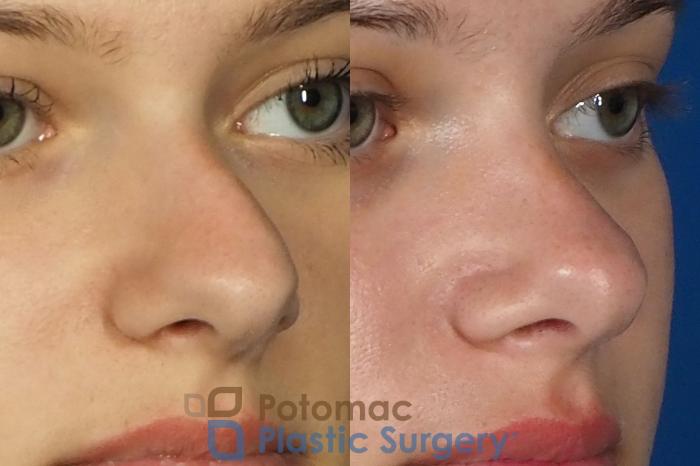 Before & After Rhinoplasty - Medical Case 249 Right Oblique View in Washington DC & Arlington , DC