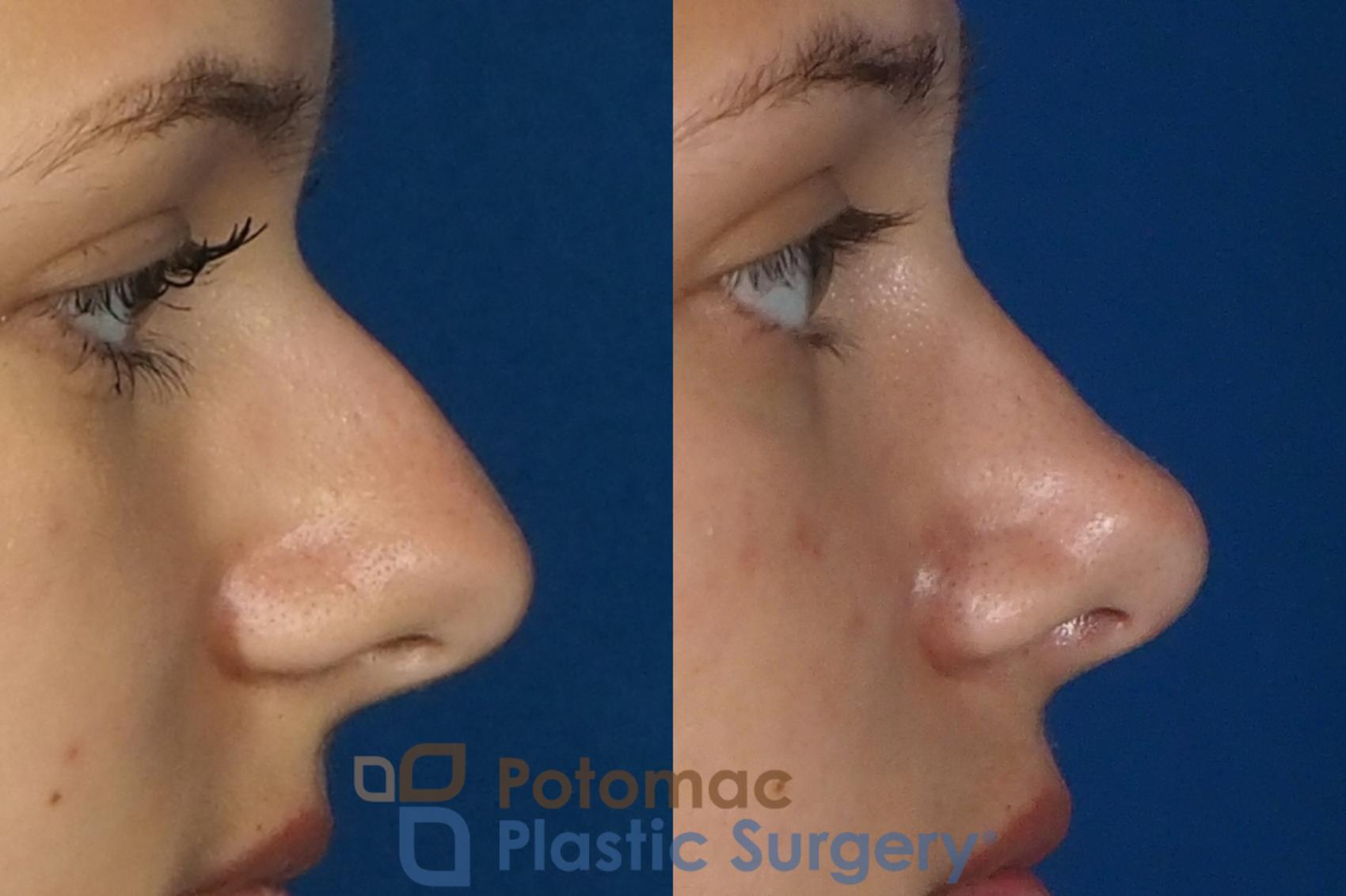 Before & After Rhinoplasty - Cosmetic Case 249 Right Side View in Washington DC & Arlington , DC