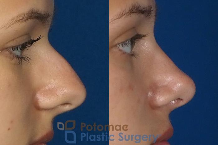 Before & After Rhinoplasty - Cosmetic Case 249 Right Side View in Washington, DC