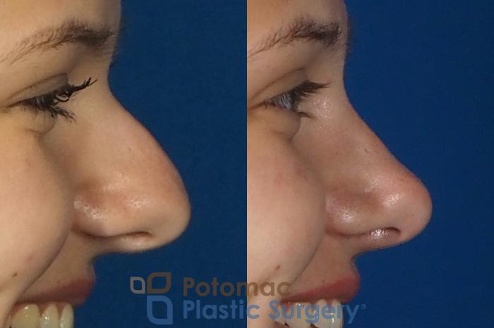 Before & After Rhinoplasty - Medical Case 249 Right View #2 View in Washington DC & Arlington , DC