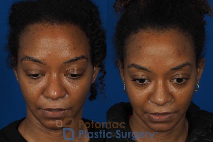 Before & After Dermal Fillers Case 253 Above View in Washington DC & Arlington , DC
