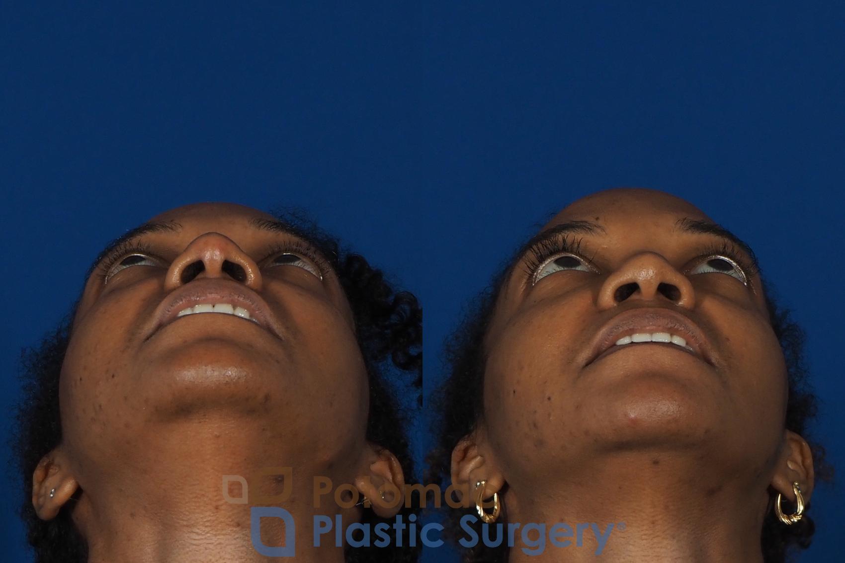 Before & After Rhinoplasty - Cosmetic Case 253 Below View in Washington DC & Arlington , DC