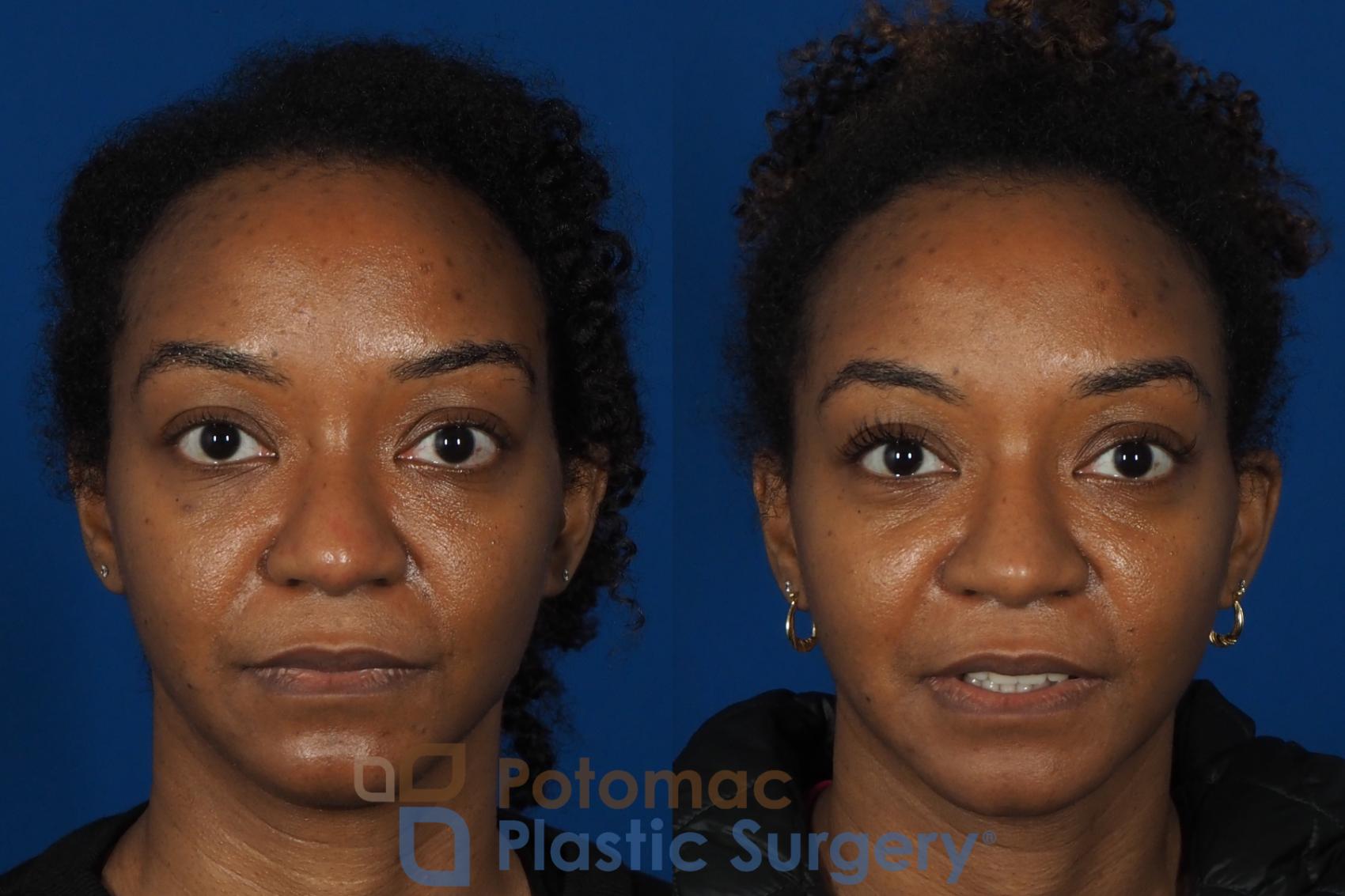 Before & After Rhinoplasty - Cosmetic Case 253 Front View #1 View in Washington DC & Arlington , DC