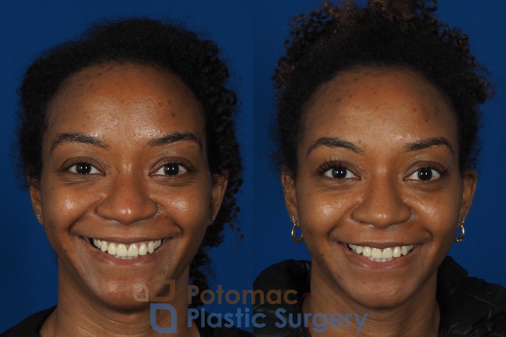 Before & After Rhinoplasty - Cosmetic Case 253 Front View #2 View in Washington DC & Arlington , DC