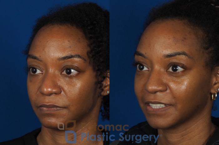 Before & After Rhinoplasty - Cosmetic Case 253 Left Oblique View in Washington DC & Arlington , DC