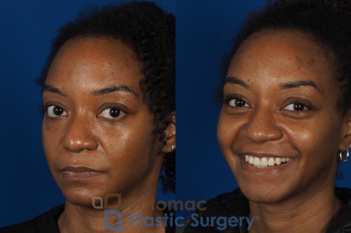 Before & After Rhinoplasty - Cosmetic Case 253 Left Oblique View #2 View in Washington DC & Arlington , DC