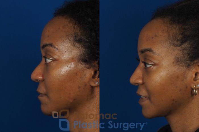 Before & After Rhinoplasty - Cosmetic Case 253 Left Side View in Washington DC & Arlington , DC