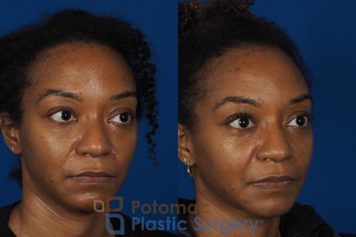 Before & After Dermal Fillers Case 253 Right Oblique View in Washington DC & Arlington , DC