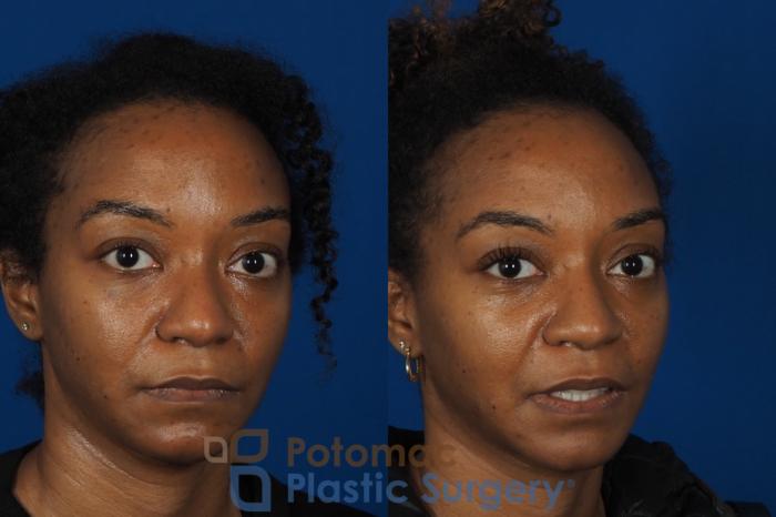 Before & After Rhinoplasty - Cosmetic Case 253 Right Oblique View #2 View in Washington DC & Arlington , DC