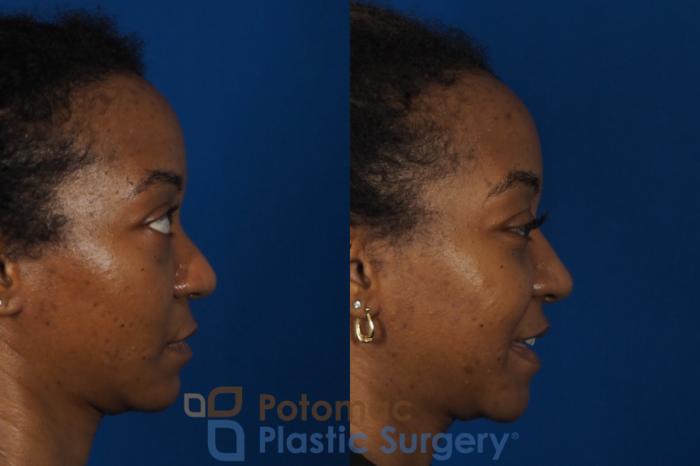 Before & After Rhinoplasty - Cosmetic Case 253 Right Side View in Washington DC & Arlington , DC