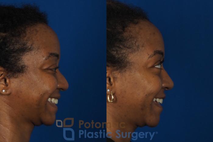 Before & After Rhinoplasty - Cosmetic Case 253 Right Side View #2 View in Washington DC & Arlington , DC