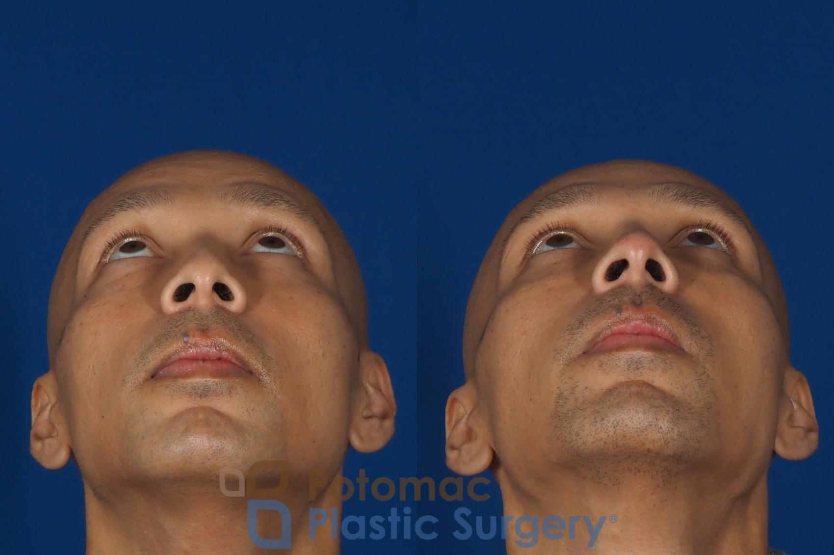 Before & After Liquid Facelift Case 255 Bottom View in Washington DC & Arlington , DC