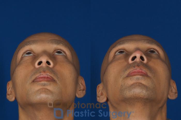Before & After Rhinoplasty - Cosmetic Case 255 Bottom View in Washington, DC