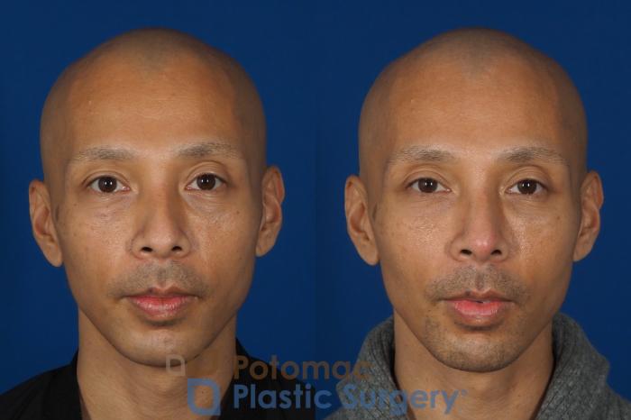 Before & After Rhinoplasty - Cosmetic Case 255 Front View in Washington, DC