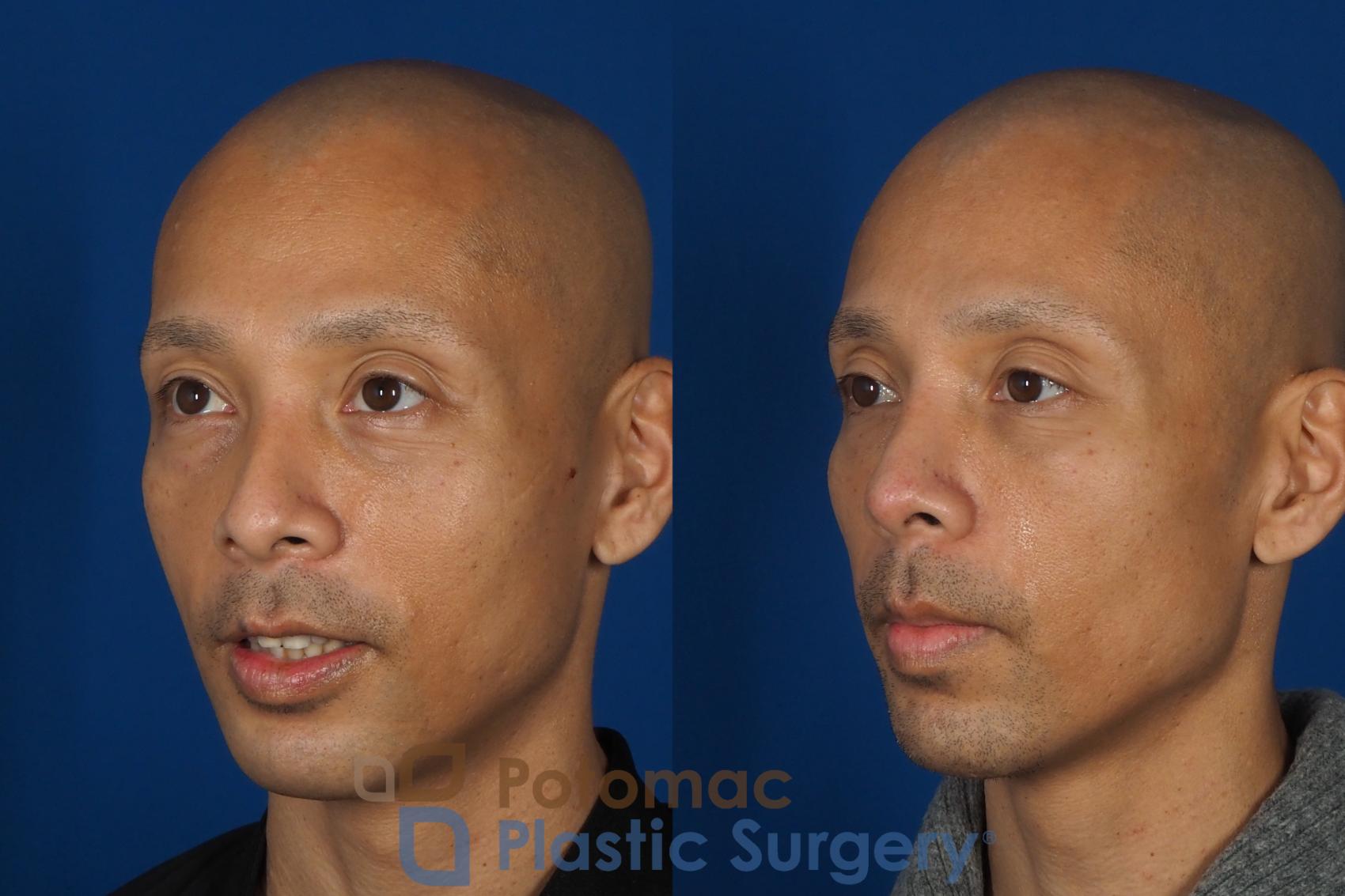 Before & After Rhinoplasty - Cosmetic Case 255 Left Oblique View in Washington, DC