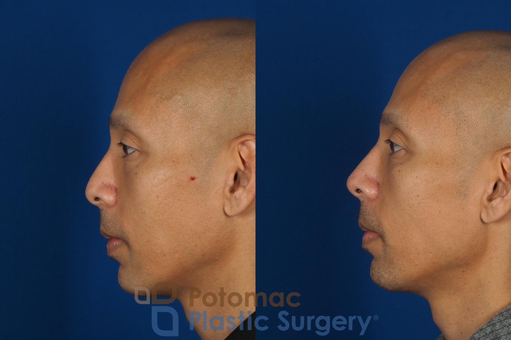 Before & After Rhinoplasty - Cosmetic Case 255 Left Side View in Washington, DC