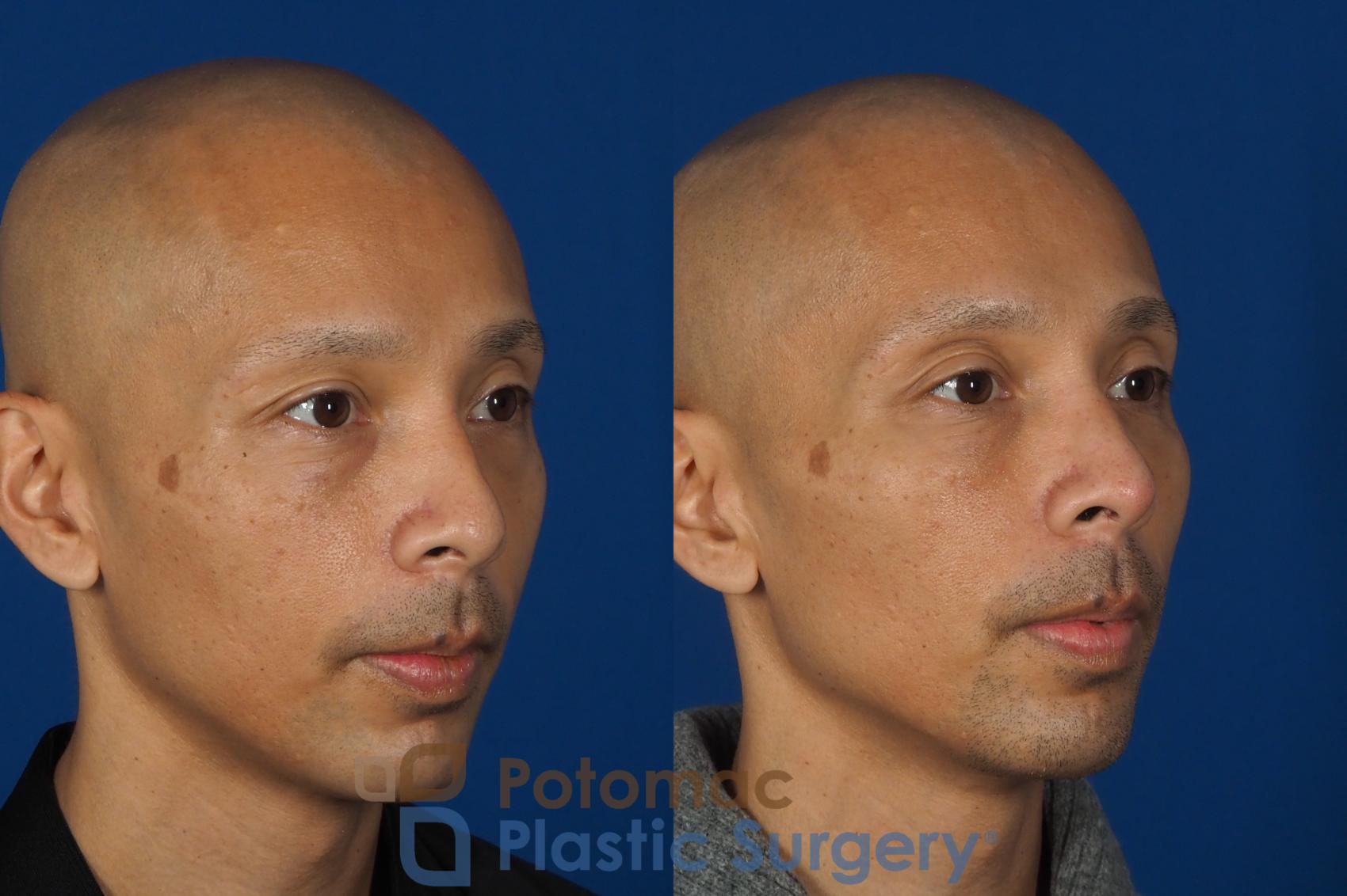 Before & After Rhinoplasty - Cosmetic Case 255 Right Oblique View in Washington, DC
