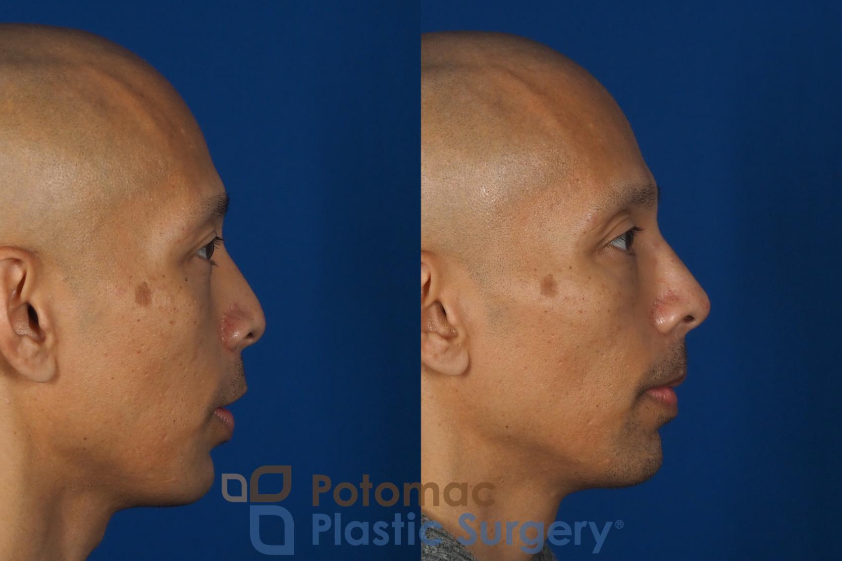Before & After Rhinoplasty - Cosmetic Case 255 Right Side View in Washington, DC