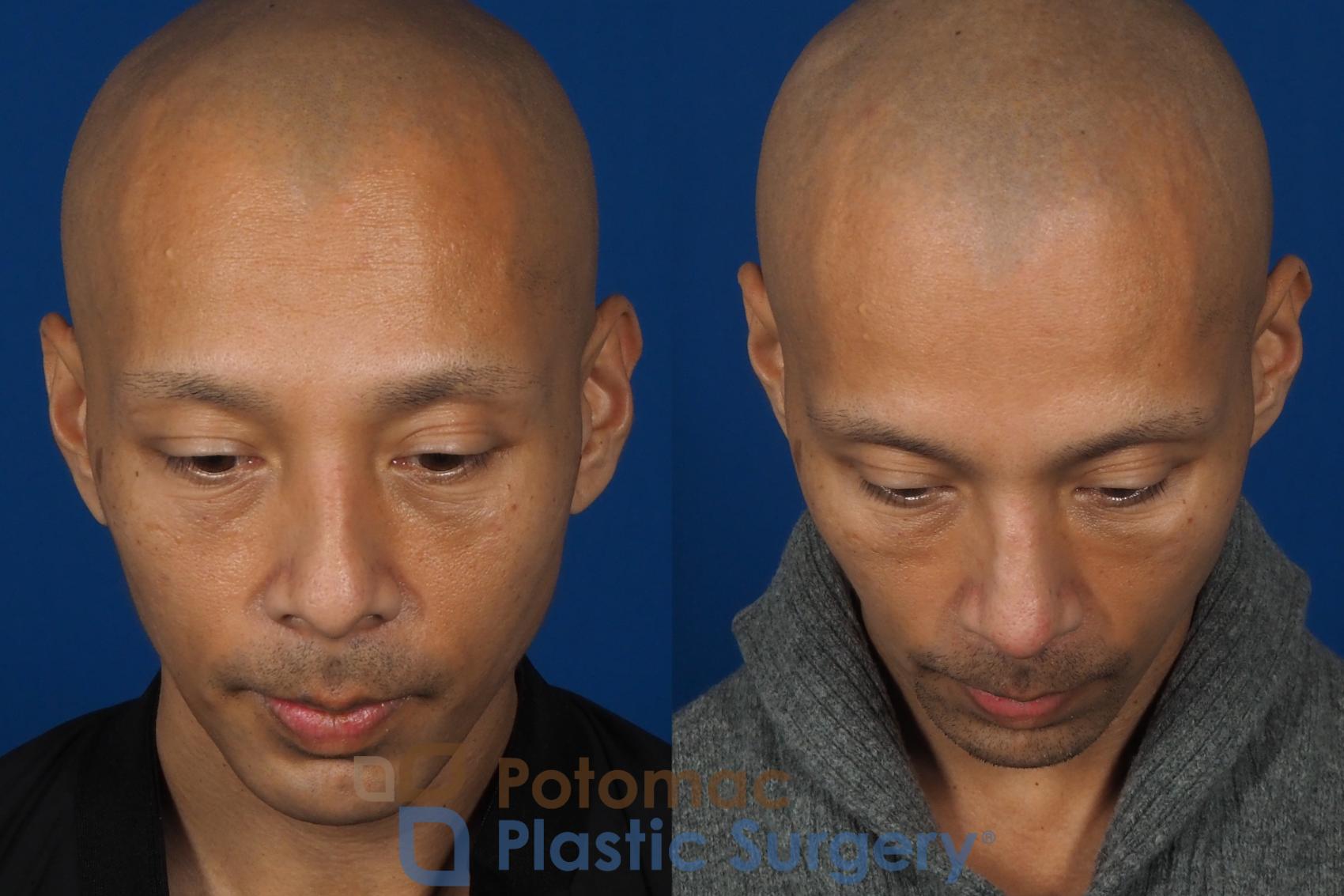 Before & After Liquid Facelift Case 255 Top View in Washington DC & Arlington , DC