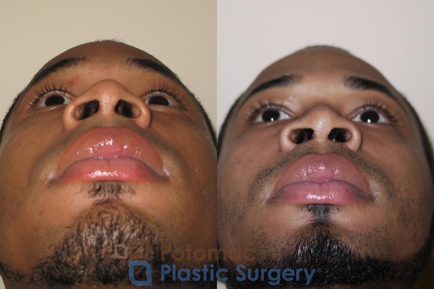 Before & After Rhinoplasty - Cosmetic Case 26 Bottom View in Washington DC & Arlington , DC