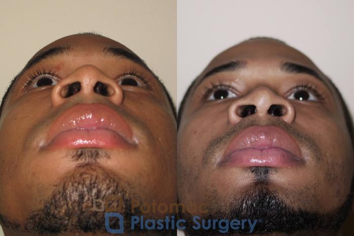 Before & After Rhinoplasty - Medical Case 26 Bottom View in Washington DC & Arlington , DC