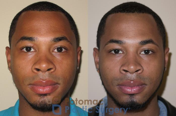 Before & After Rhinoplasty - Medical Case 26 Front View in Washington DC & Arlington , DC