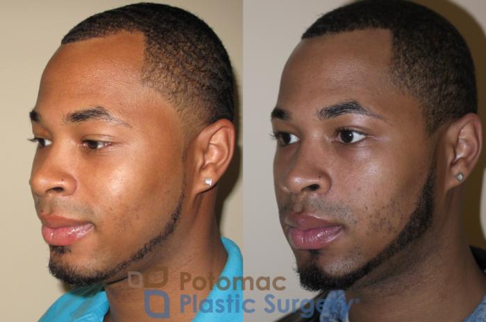 Before & After Rhinoplasty - Medical Case 26 Left Oblique View in Washington DC & Arlington , DC