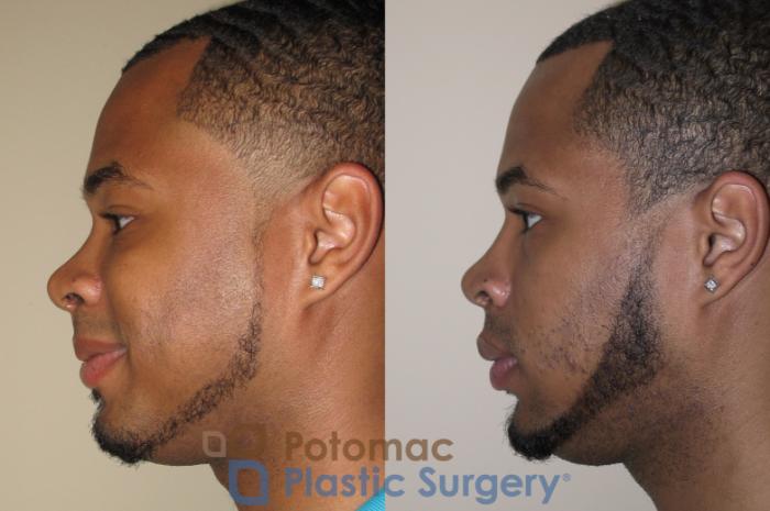 Before & After Rhinoplasty - Medical Case 26 Left Side View in Washington DC & Arlington , DC