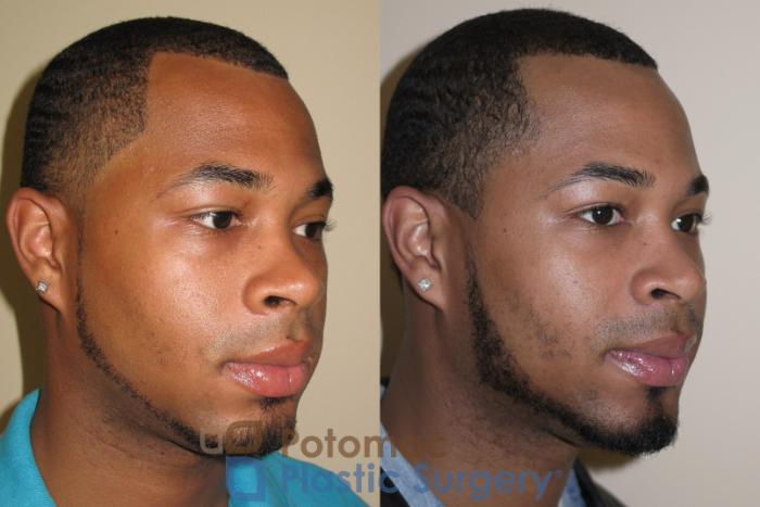 Before & After Rhinoplasty - Medical Case 26 Right Oblique View in Washington DC & Arlington , DC