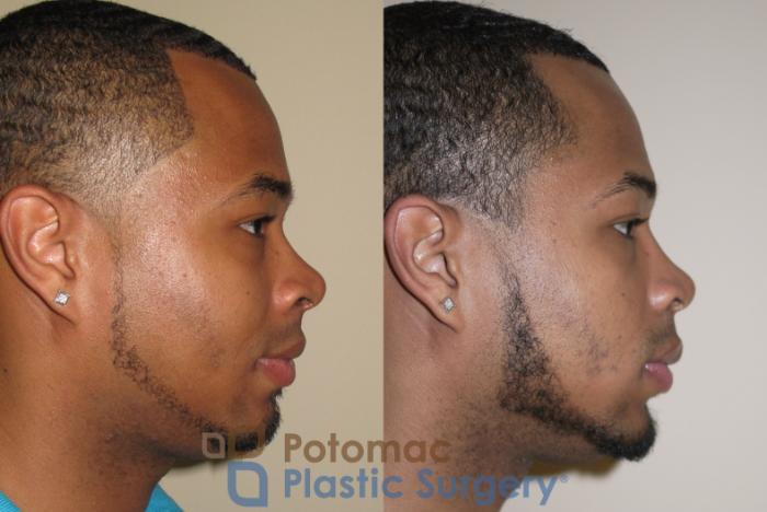 Before & After Rhinoplasty - Medical Case 26 Right Side View in Washington DC & Arlington , DC