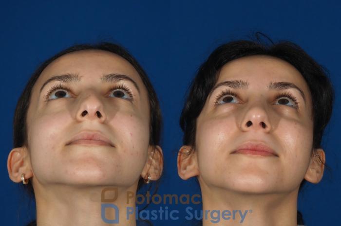 Before & After Rhinoplasty - Cosmetic Case 262 Bottom View in Washington DC & Arlington , DC
