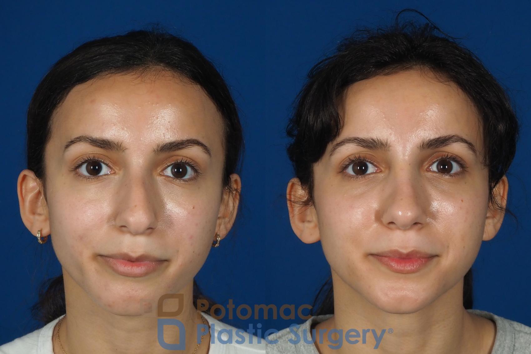 Before & After Rhinoplasty - Cosmetic Case 262 Front View in Washington, DC