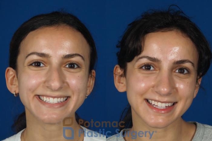Before & After Rhinoplasty - Cosmetic Case 262 Front - Smiling View in Washington DC & Arlington , DC