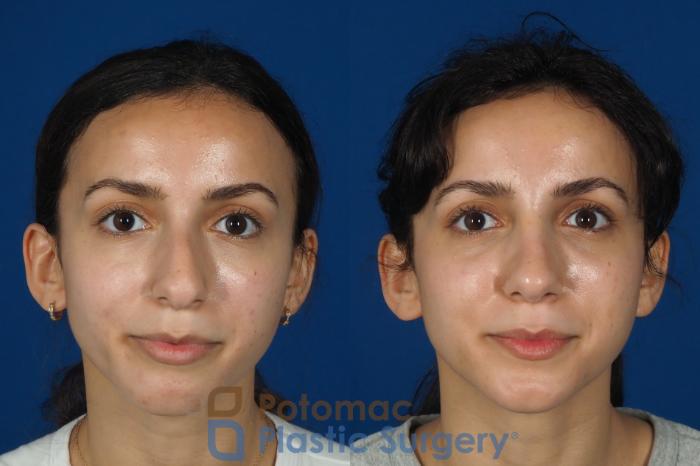 Before & After Rhinoplasty - Cosmetic Case 262 Front View in Washington DC & Arlington , DC