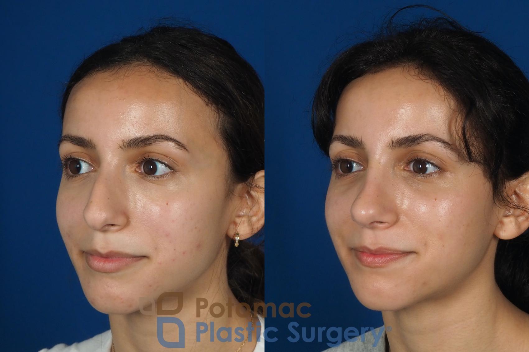 Before & After Rhinoplasty - Cosmetic Case 262 Left Oblique View in Washington DC & Arlington , DC