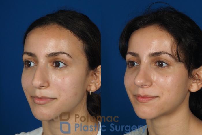 Before & After Rhinoplasty - Cosmetic Case 262 Left Oblique View in Washington DC & Arlington , DC