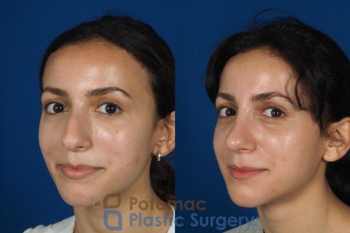 Before & After Rhinoplasty - Cosmetic Case 262 Left Oblique View #2 View in Washington DC & Arlington , DC