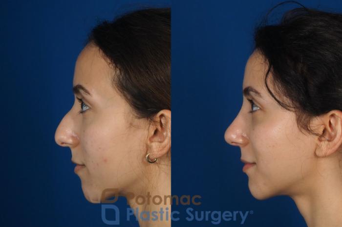 Before & After Rhinoplasty - Cosmetic Case 262 Left Side View in Washington DC & Arlington , DC