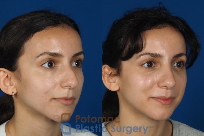 Before & After Rhinoplasty - Cosmetic Case 262 Right Oblique View in Washington DC & Arlington , DC
